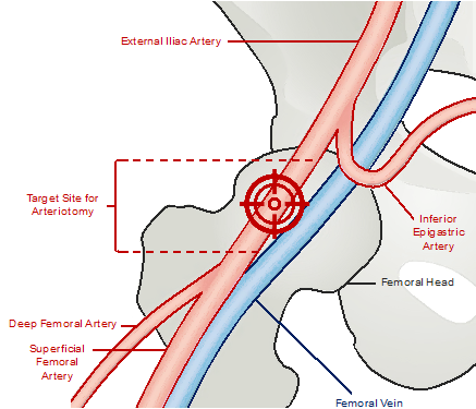 Image showing femoral arterial anatomy with the ideal target site of arteriotomy being above the bifurcation and below the inferior epigastric artery on the femoral head.